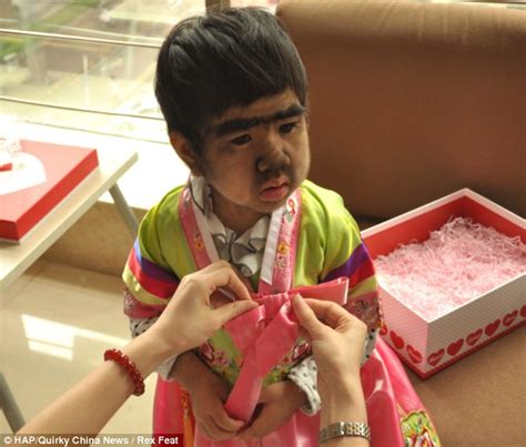 chinese girl jing jing with rare genetic werewolf syndrome to receive treatment daily mail