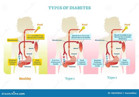 types  diabetes vector illustration diagram scheme stock vector illustration  diabetic