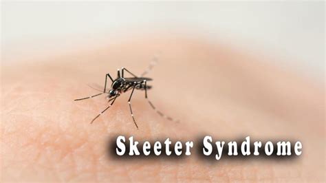 skeeter syndrome    mosquito