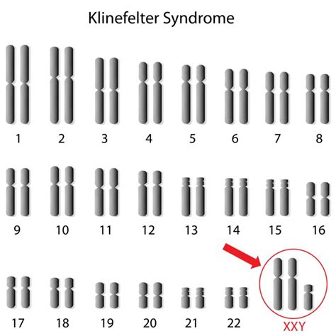 47 Xxy Klinefelter Syndrome Genassist