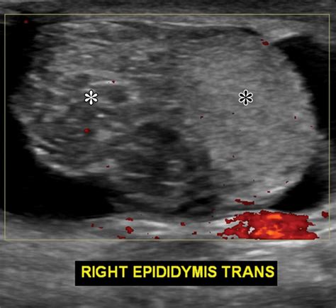 imaging of penile and scrotal emergencies radiographics