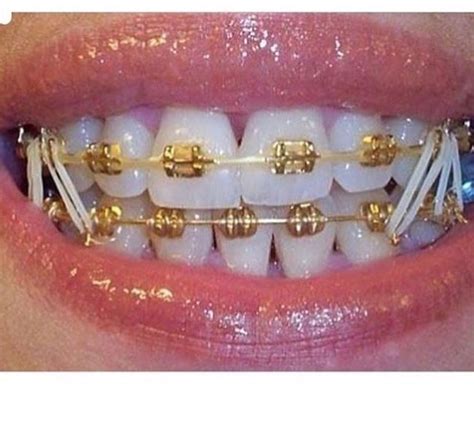 pin by carly on things to do dental braces braces colors cute