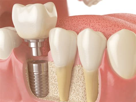 bone grafting  dental implants        work