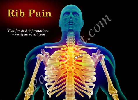 Rib Pain Classification Types Pathophysiology Causes Signs