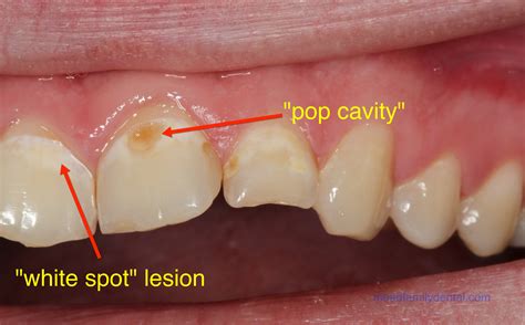 pop cavities mead family dental