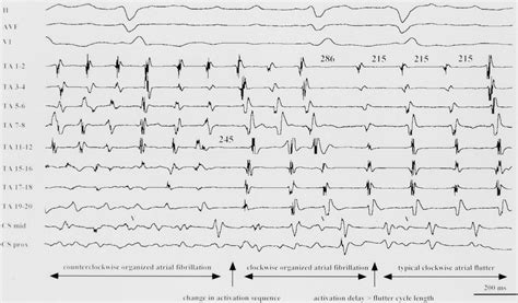 relationship between atrial fibrillation and typical atrial flutter in