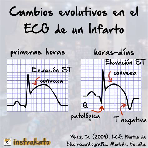 evolucion del iam en el electrocardiograma ekg electrocardiograma