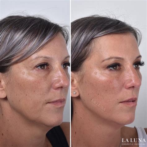 thread lift sydney 1 cosmetic doctors face neck and cheek lift