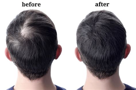 laser therapy  hairloss tigard life