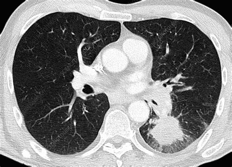 Lung Cancer Ct Scan Stock Image C018 7153 Science