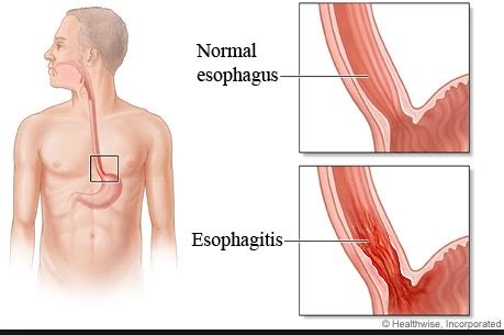 apoteker  tahu efek samping obat  menyebabkan radang esofagus