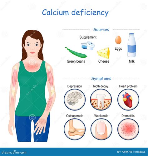 symptoms  calcium deficiency infographics cartoon vector cartoondealercom