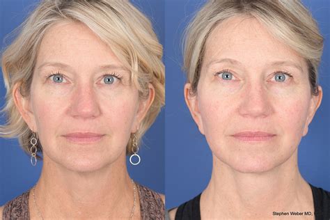 Necklift Before And After 18 Weber Facial Plastic Surgery