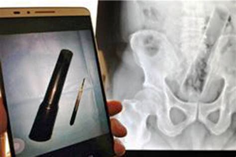 man refuses to tell docs how 10 inch torch became lodged in anus