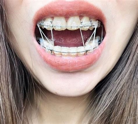 Braces Girlswithbraces Clearbraces Elastics Powerchain Dental