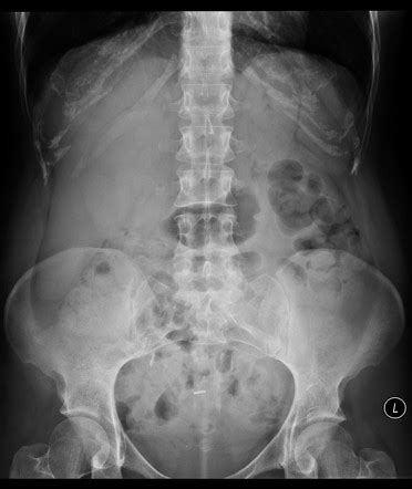 normal abdominal  ray radiology case radiopaediaorg