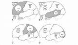 Seizure Esp Mri Epileptic Resonance Lesion Publication sketch template