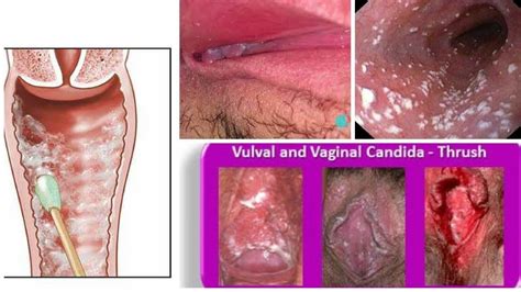 yeast infection on the vigina cure blisters sector