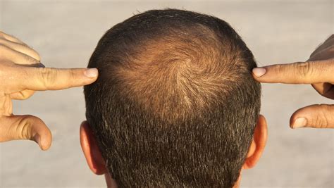 losing your hair safe effective options exist to help restore growth