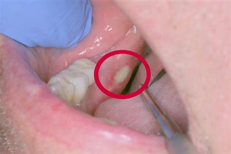 oral pathology rancho mirage oral cancer screen mouth