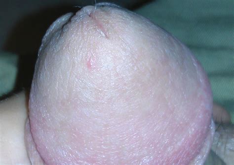 I Have A Single Red Spot On The Head Of My Penis