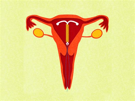 When Is It Ok To Get Your Iud Removed Self