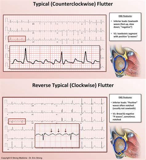 Typical Counterclockwise Atrial Flutter With Variable Atrioventricular