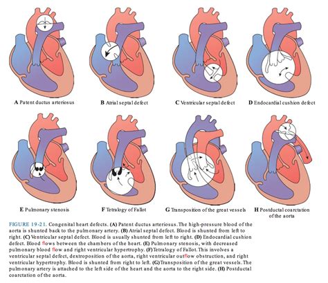 advanced pathophysiology congenital heart defects congenital heart