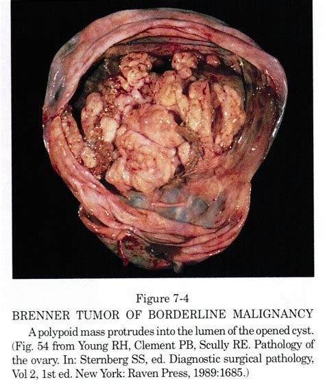 pathology outlines borderline brenner tumor