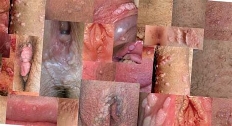 Genital Warts Genital Cures Removal And Pictures