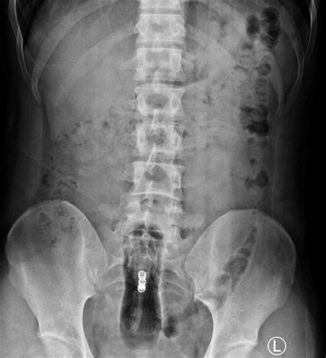 figure 1 pelvic radiograph revealed a well defined radiolucent foreign