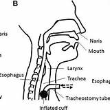 Tracheostomy Laryngectomy sketch template