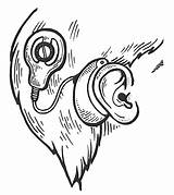 Implant Cochlear Vecteur Implants Engraving Cochléaire Jouet Gravant sketch template