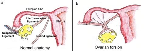 ovarian torsion  symptoms diagnosis ovarian torsion treatment