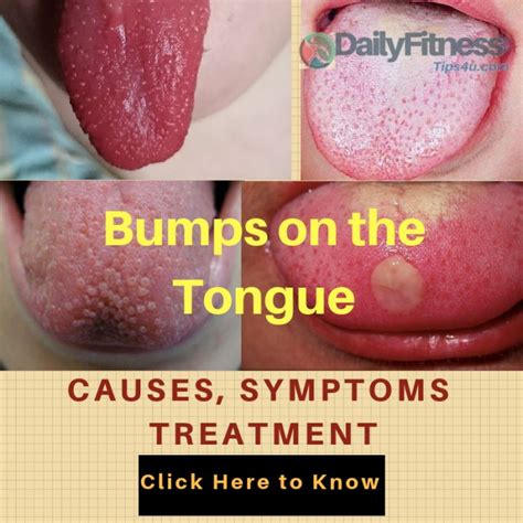 white bump  tongue cancer