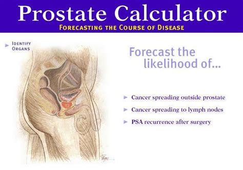 Prostate Calculator Santa Barbara Urologist David J Laub Md