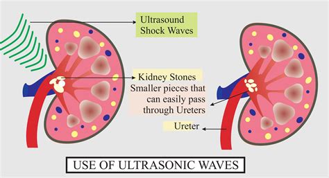 ultrasonic waves write     ultrasonic waves