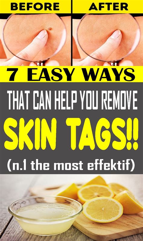 here are 7 easy ways that can help you remove skin tags remedies