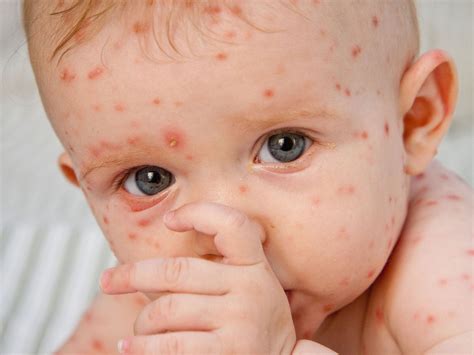 chickenpox vaccine trialed in uk hospitals the independent the