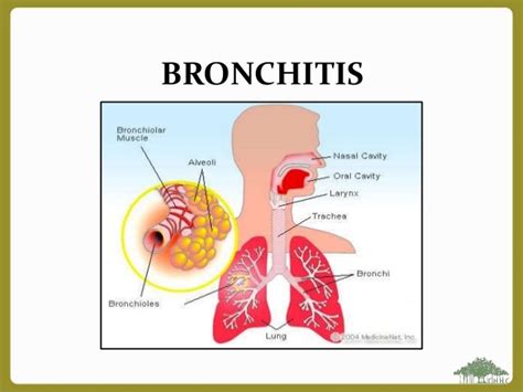 bronchitis medical blog bronchitis bacterial infection