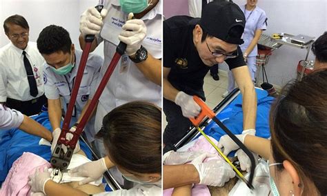 thai man has a sex ring removed with boltcutters after it became stuck on his penis daily mail