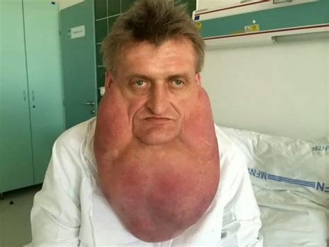 Stefan Zoleik Doctors Remove Giant Tumour From Face Of Slovakian Man