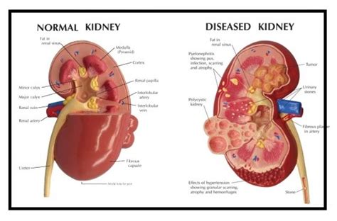 chronic kidney disease elim rheumatic centre