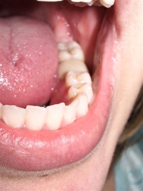 dent devitalisee dent mortifiee dent sans pulpe