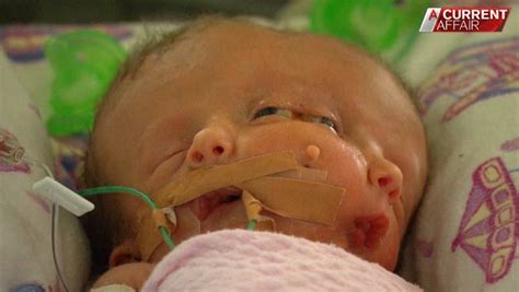 Conjoined Twins Born With One Body But Two Faces Fight For