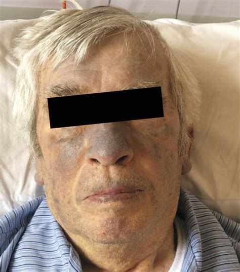 antiarrhythmic agent linked  patients blue gray skin discoloration
