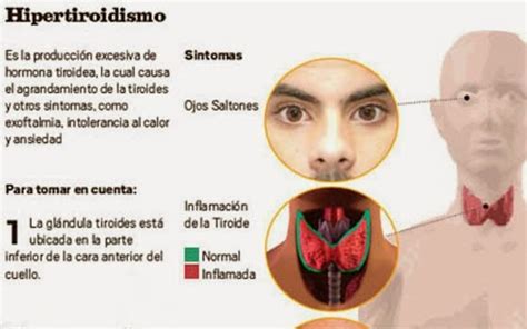 hablemos de salud hipertiroidismo síntomas causas y terapias naturales