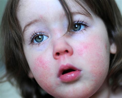 Scarlet Fever Cases On The Rise What To Look Out For Families Online