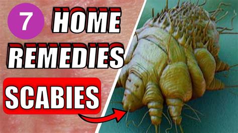 7 effective scabies home natural treatments how to get rid of scabies