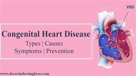 congenital heart disease types  symptoms prevention